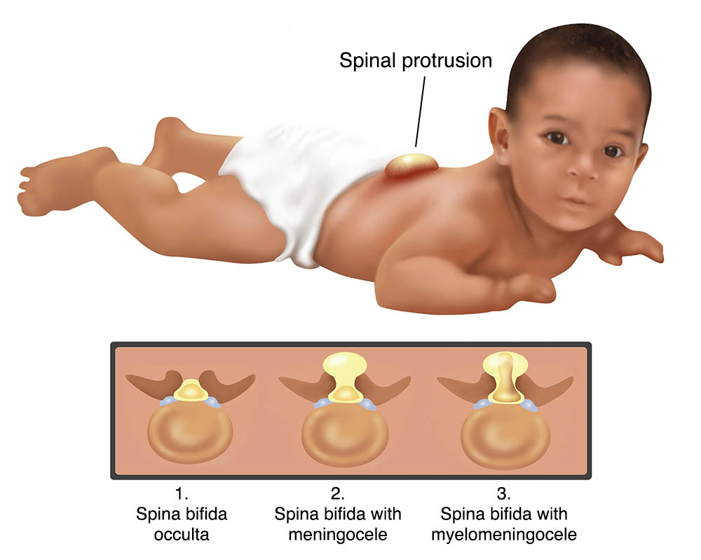 Form Of Spina Bifida Living With Spina Bifida Infants BZLU