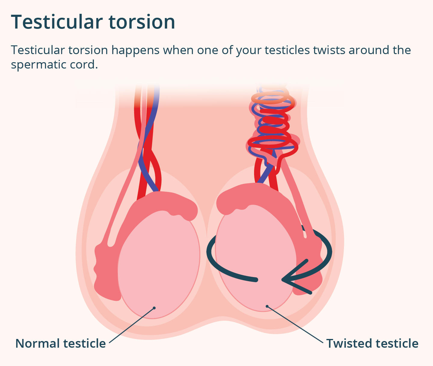 Illustration showing a normal testicle next to a testicle that has twisted, illustrating testicular torsion.