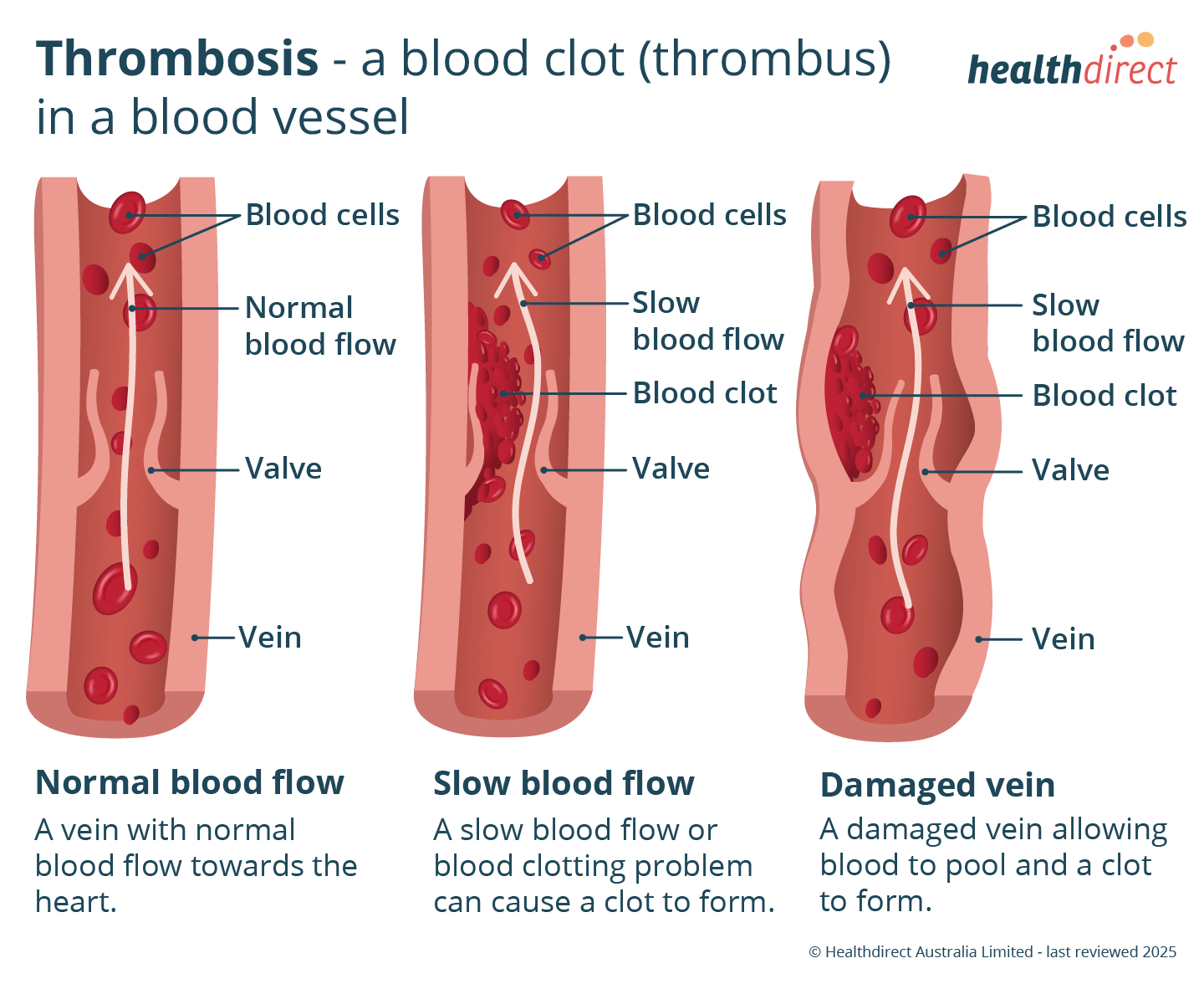 Illustration showing a normal vein in comparison to thrombosis (a blood clot).