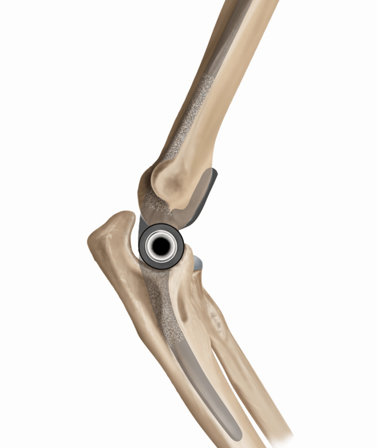 Illustration of a total elbow replacement.