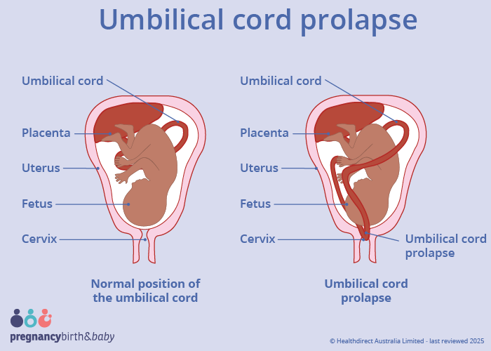 Image title Illustration of an umbilical cord prolapse