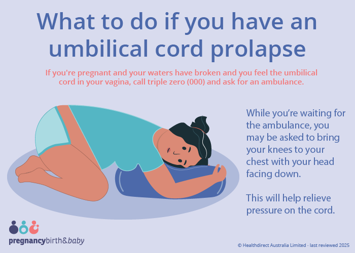 Image title What to do if you have umbilical cord prolapse