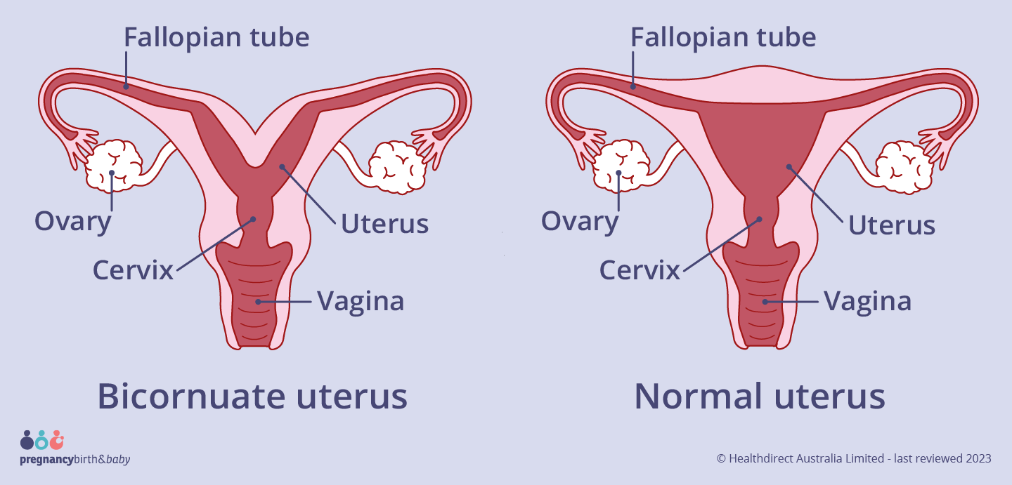 Bicornuate Uterus Treatment Bicornuate Uterus SpringerLink Bicornuate Uterus Treatment Bicornuate Uterus SpringerLink