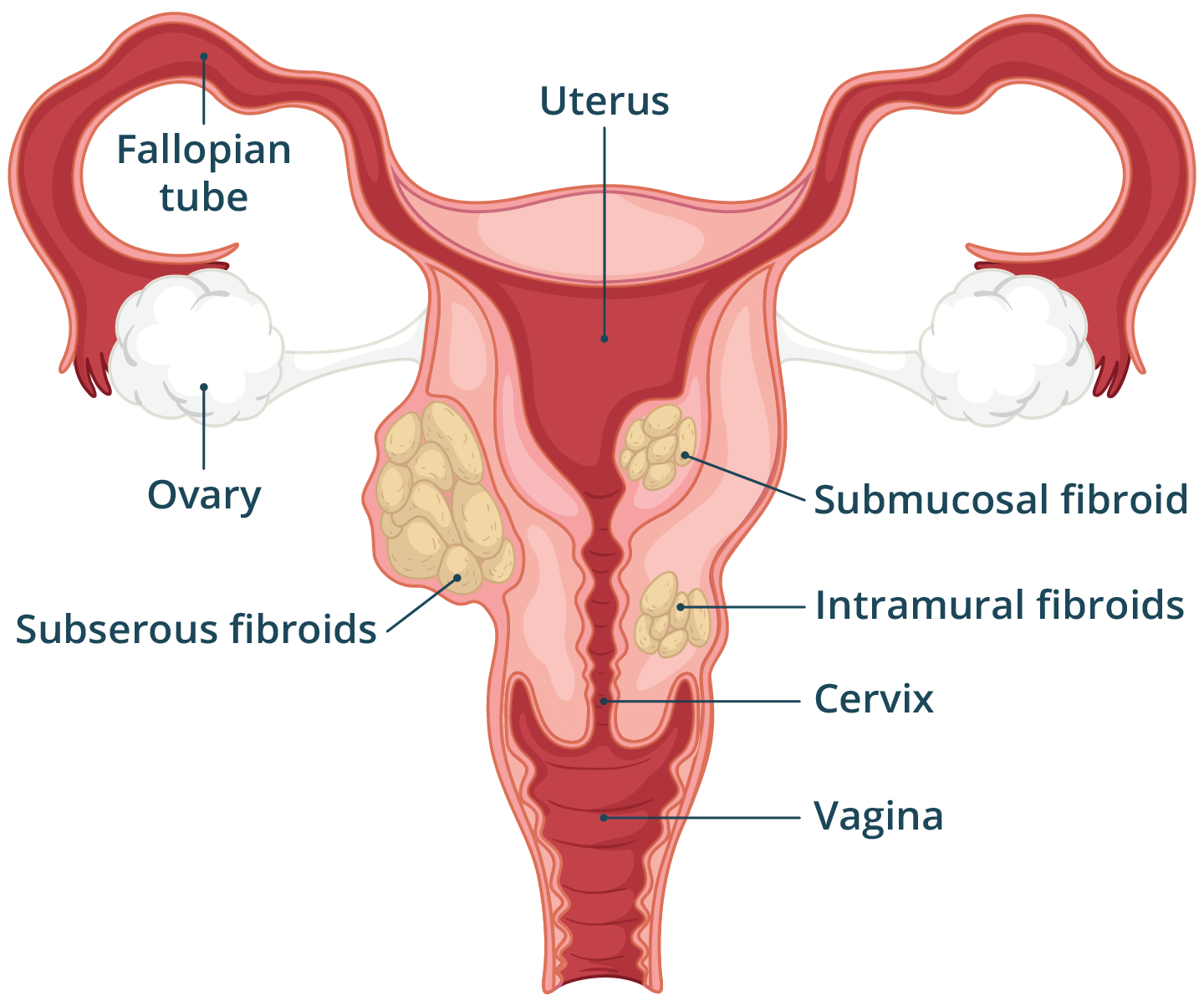 Illustration of the female reproductive system with uterine fibroids growing in and around the uterus.