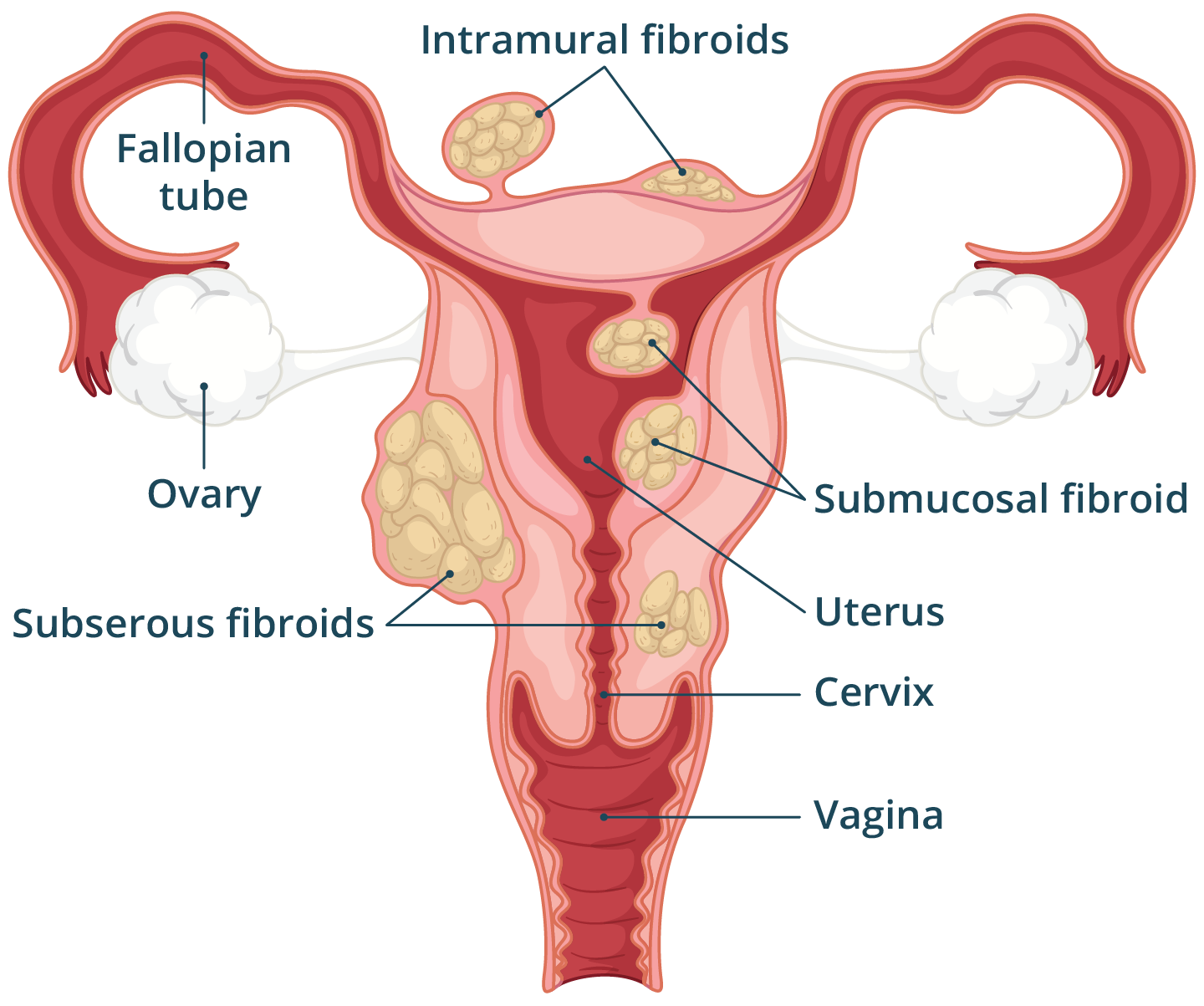 Illustration of the female reproductive system with uterine fibroids growing in and around the uterus.