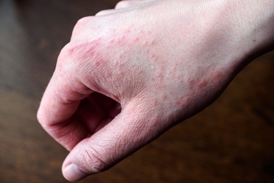 Photo of eczema on the pointer finger and thumb.