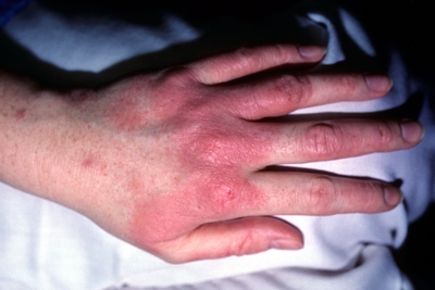 Photo of eczema on the back of the hand and fingers