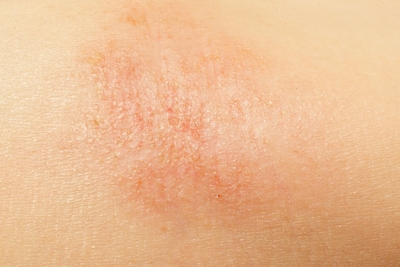 Close up photo of eczema on arm skin.