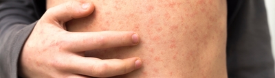 Infectious diseases Infectious diseases