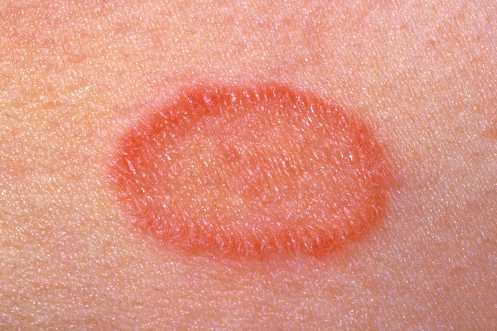 Bye Bye Theme Meter Pink Spots On Skin Fatigue Get Tangled Bedroom