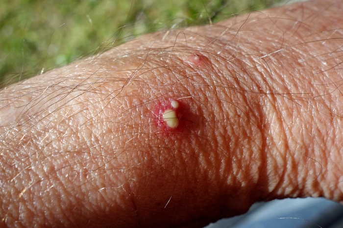 A close-up image of a man's forearm showing three inflamed pustular blisters, each surrounded by reddened skin, a reaction to a fire ant bite.